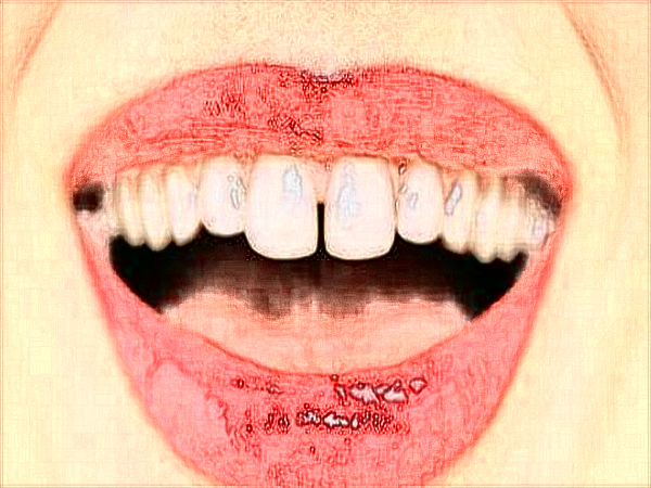 2024中山大學附屬口腔醫(yī)院洗牙收費標準?洗牙能讓牙變白?