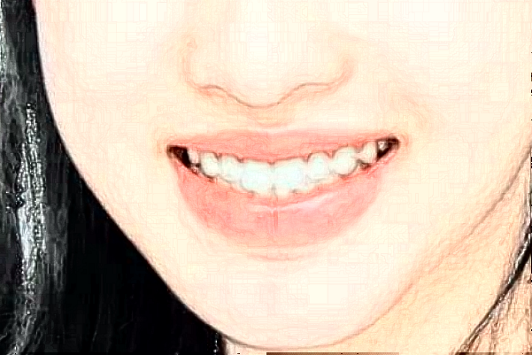 2024江蘇大學附屬醫(yī)院種牙做的好嗎_種牙后注意事項有哪些