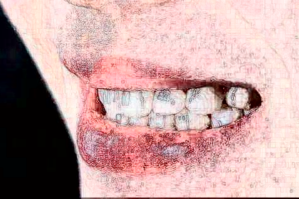 天津醫(yī)科大學(xué)第二醫(yī)院口腔科義齒修復(fù)價(jià)目表(價(jià)格表)怎么樣