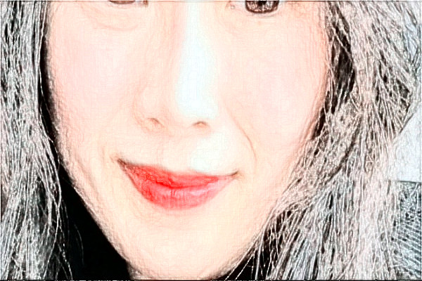 2024南京中大醫(yī)院激光除皺做的怎么樣【整形案例分享】