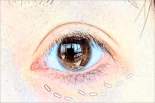 2024中山大學(xué)附屬第一醫(yī)院近視費(fèi)用?近視有用嗎