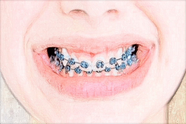 2024青島市立醫(yī)院正畸費(fèi)用?正畸和矯正有什么區(qū)別