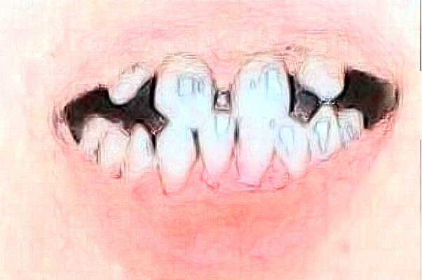 2024太原市中心醫(yī)院口腔科種植修復(fù)怎么樣?實(shí)測(cè)案例分享