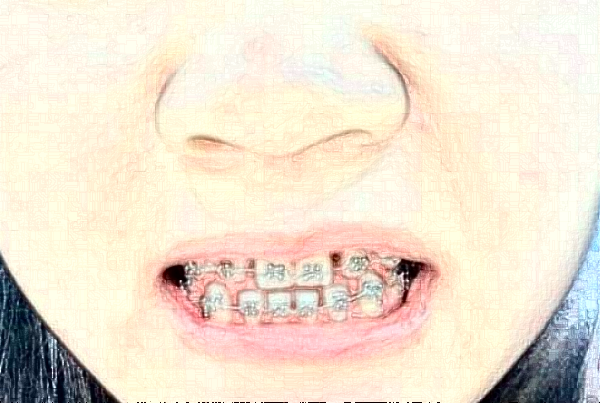 南京中大醫(yī)院口腔科牙頜畸形矯正做的怎么樣_誰做的比較好