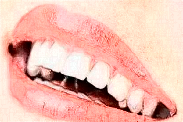 天津市第三中心醫(yī)院口腔科前牙美容修復(fù)做的好嗎?案例反饋