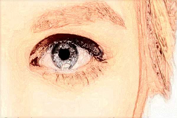 2024南寧303醫(yī)院近視矯正價格?近視矯正手術(shù)副作用