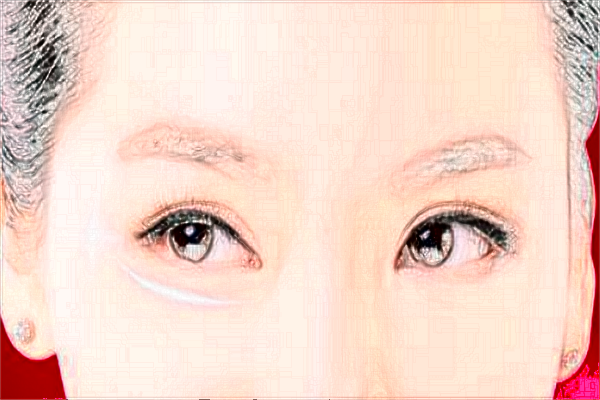 2024哈爾濱醫(yī)科大學附屬第一醫(yī)院去眼袋做的怎么樣_去眼袋手術有危害嗎