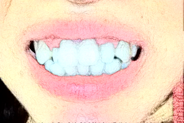 太原市中心醫(yī)院口腔科種植牙價格嘗鮮版_體驗日記分享