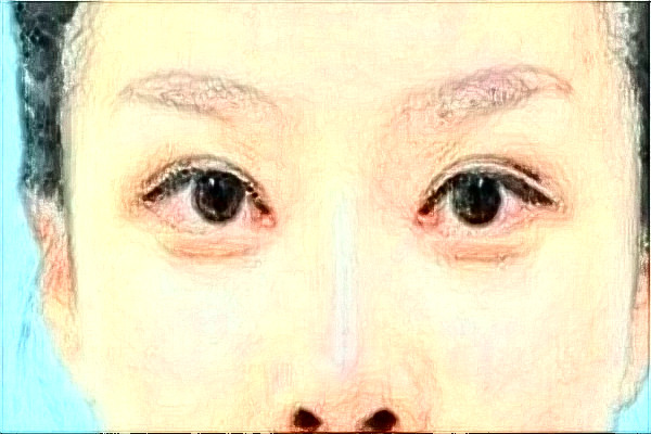 河北省人民醫(yī)院自體脂肪填充面部做的好嗎?真實案例反饋