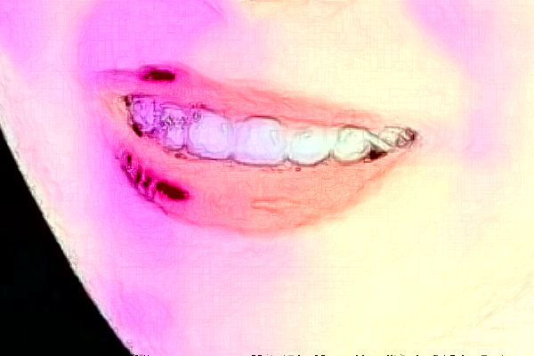 大連大學附屬中山醫(yī)院口腔科拔牙做的好嗎_拔牙整形日記