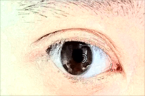 2024中山大學附屬第三醫(yī)院近視手術多少錢?近視手術有風險嗎