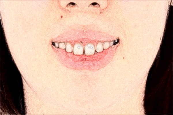 2024中山大學附屬第三醫(yī)院牙齒矯正多少錢?牙齒矯正需要多久