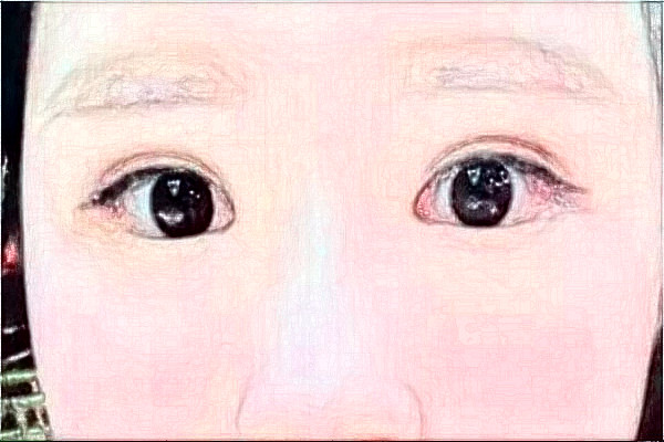 2024南京鼓樓醫(yī)院去眼袋怎么樣_體驗日記分享