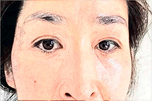 2024南京鼓樓醫(yī)院去眼袋怎么樣_體驗日記分享