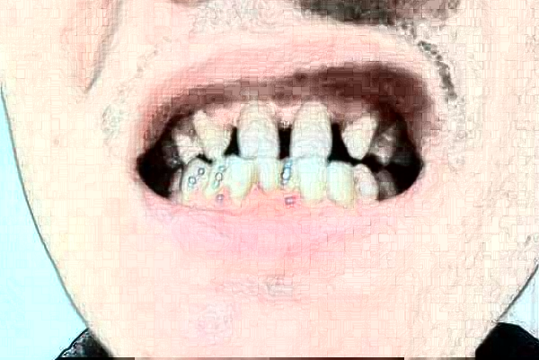 天津醫(yī)科大學(xué)第二醫(yī)院口腔科隱形正畸怎么樣_醫(yī)生排名