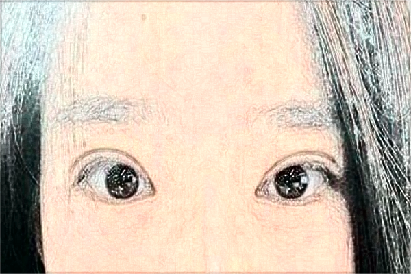 2024大連醫(yī)科大學附屬第一醫(yī)院做雙眼皮做的好嗎_醫(yī)生技術(shù)好不好