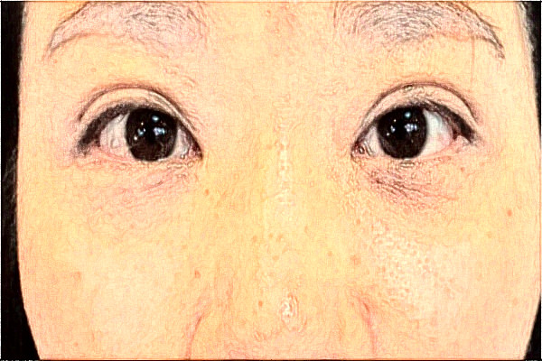 2024天津市醫(yī)科大學(xué)眼科醫(yī)院全飛秒做的好嗎?誰做得好