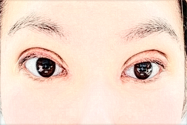 天津醫(yī)科大學(xué)總醫(yī)院割雙眼皮做的怎么樣_哪位醫(yī)生技術(shù)比較好