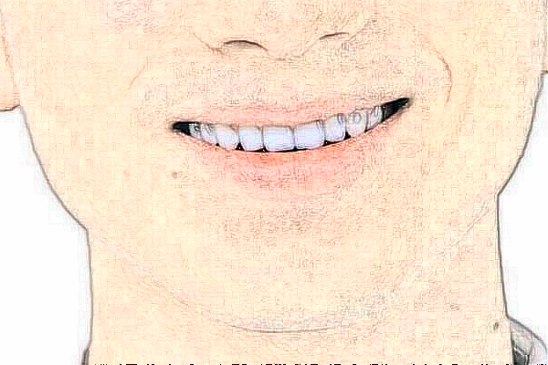 江蘇省人民醫(yī)院活動義齒修復做的好嗎【真實案例分享】