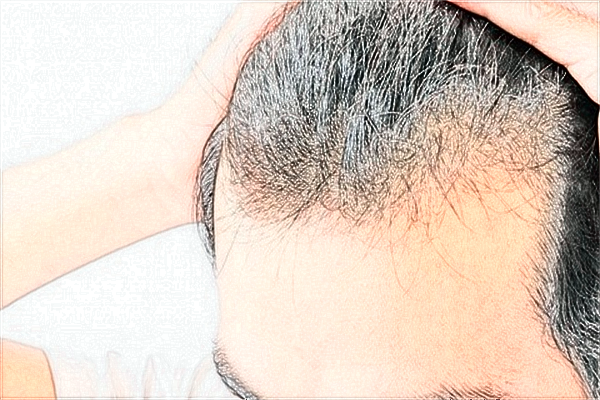 2024青島市立醫(yī)院植發(fā)費(fèi)用?植發(fā)需要把頭發(fā)剃光嗎