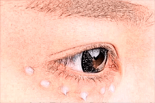 2024蘭州大學第二醫(yī)院飛秒價格?飛秒手術(shù)有什么風險