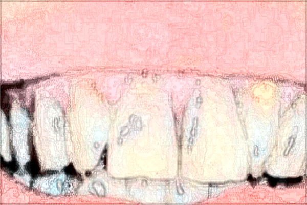 2024煙臺毓璜頂醫(yī)院拔智齒費用?拔智齒注意事項與禁忌