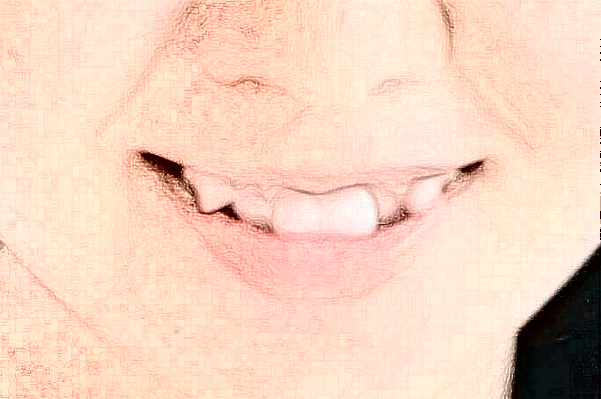 沈陽盛京醫(yī)院根管價格多少_真實案例分享