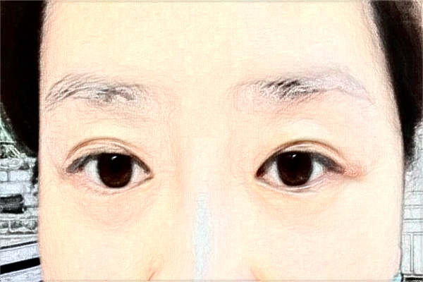 大慶市人民醫(yī)院全飛秒做的好嗎?誰做得好