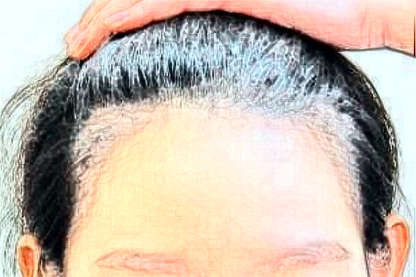 2024無(wú)錫市第一人民醫(yī)院植發(fā)怎么樣_醫(yī)生名單推薦