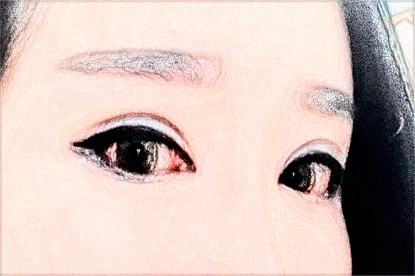 2024安徽省立醫(yī)院填充淚溝需要多少錢?醫(yī)生推薦