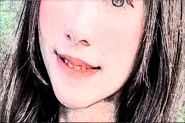 南通大學(xué)附屬醫(yī)院去胎記怎么樣_體驗日記分享