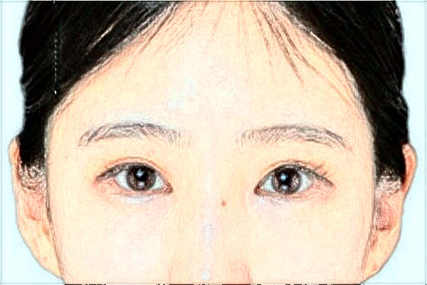 綿陽市中心醫(yī)院激光美容怎么樣_真實案例反饋