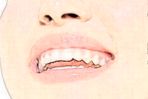 2024蘇北人民醫(yī)院義齒修復(fù)價(jià)目表_口碑怎么樣