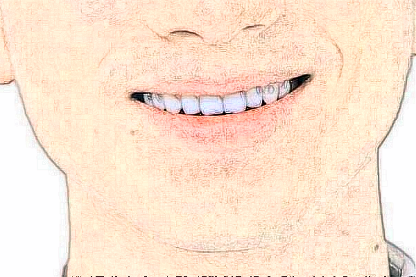 2024青島海慈醫(yī)院補(bǔ)牙多少錢(qián)?補(bǔ)牙材料是什么