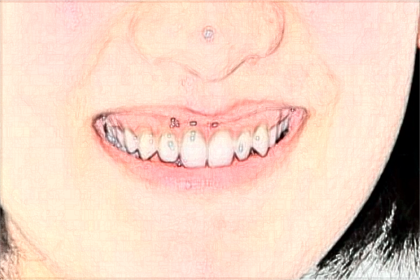 2024太原眾牙口腔醫(yī)院牙齒美白多少錢(qián)?做的怎么樣