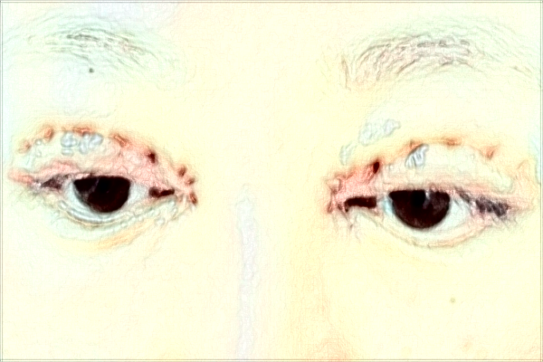 南通大學(xué)附屬醫(yī)院割雙眼皮價(jià)目表(價(jià)格表)怎么樣