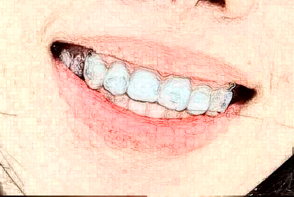 ?？谑腥嗣襻t(yī)院種植牙怎么樣?種植牙有后遺癥嗎