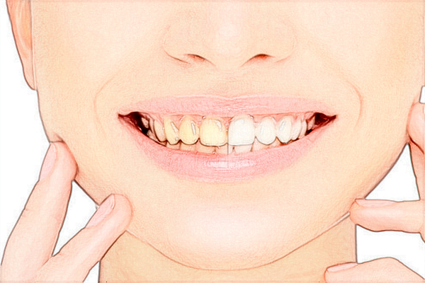 2024惠州市中心人民醫(yī)院矯正牙齒費(fèi)用?牙齒矯正有用嗎