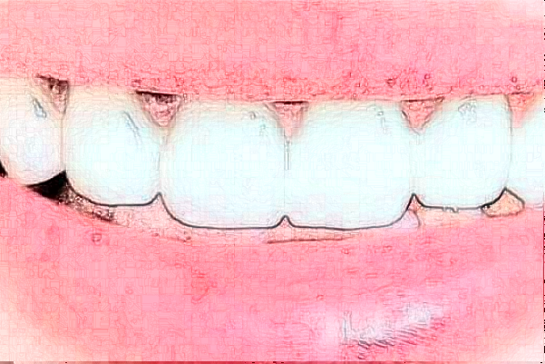 2024上海華美醫(yī)療美容醫(yī)院牙齒正畸費(fèi)用多少_真實(shí)案例反饋