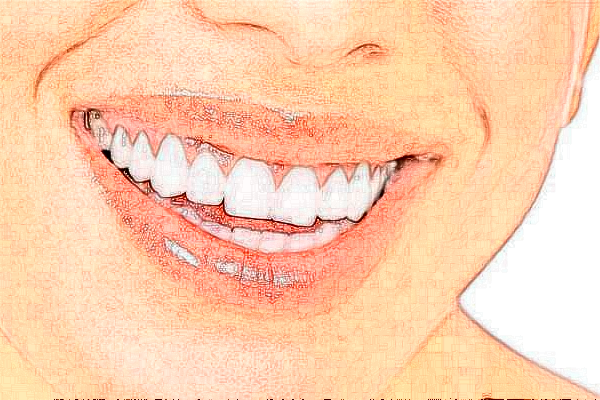 成都圣貝牙科醫(yī)院自鎖矯正價(jià)格多少?整形日記全過程分享