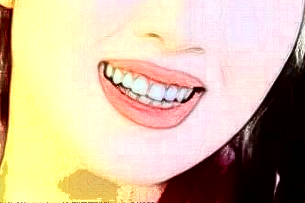 長(zhǎng)沙科爾雅口腔醫(yī)院樹(shù)脂補(bǔ)牙價(jià)格多少?整形日記全過(guò)程分享