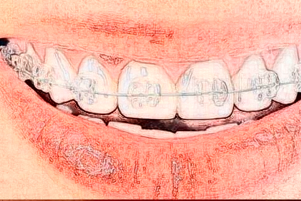 2024山東省千佛山醫(yī)院拔牙費用?拔牙后有什么注意事項