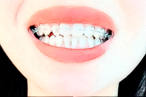 2024懷化市第一人民醫(yī)院根管價格?根管后多久做牙冠