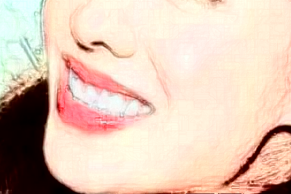 2024中山大學(xué)附屬口腔醫(yī)院矯正牙齒的費用?矯正牙齒的步驟