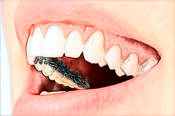 自貢華醫(yī)口腔醫(yī)院種牙好不好?種牙的好處與危害