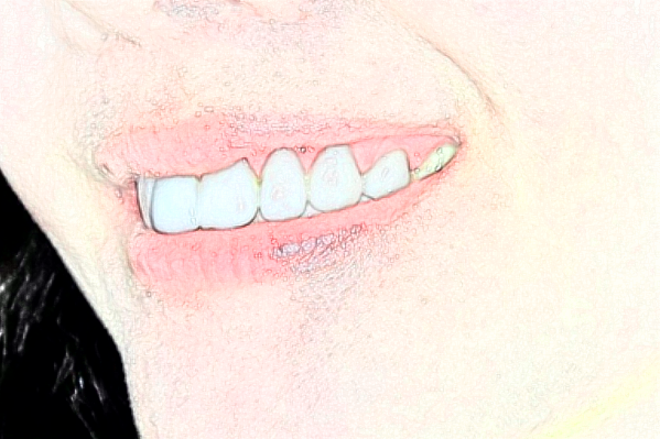 2024成都新橋口腔醫(yī)院拔牙價格表?拔牙后的注意事項(xiàng)