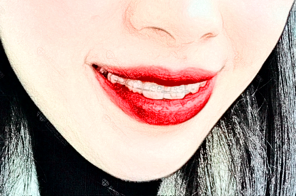 2024成都新橋口腔醫(yī)院烤瓷牙價(jià)格?烤瓷牙和全瓷牙的區(qū)別