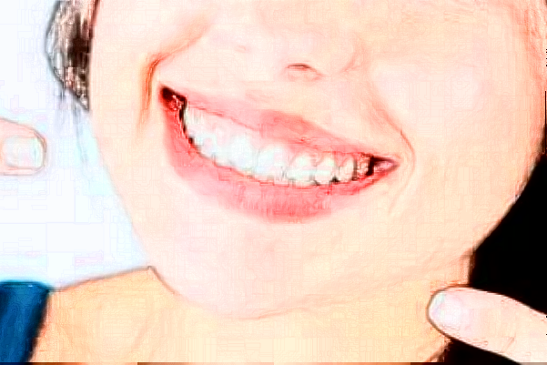 2024成都新橋口腔醫(yī)院補(bǔ)牙價(jià)格?補(bǔ)牙要多久時(shí)間