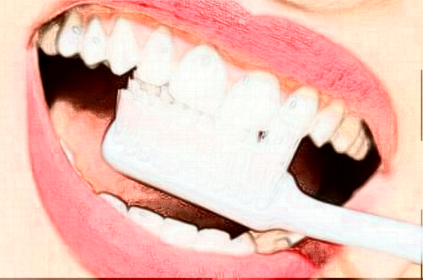 山西省人民醫(yī)院錯頜畸形矯正費用多少?整形日記全過程