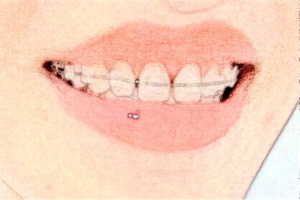 杭州植得口腔門診部根管做的好嗎?哪位醫(yī)生做得好